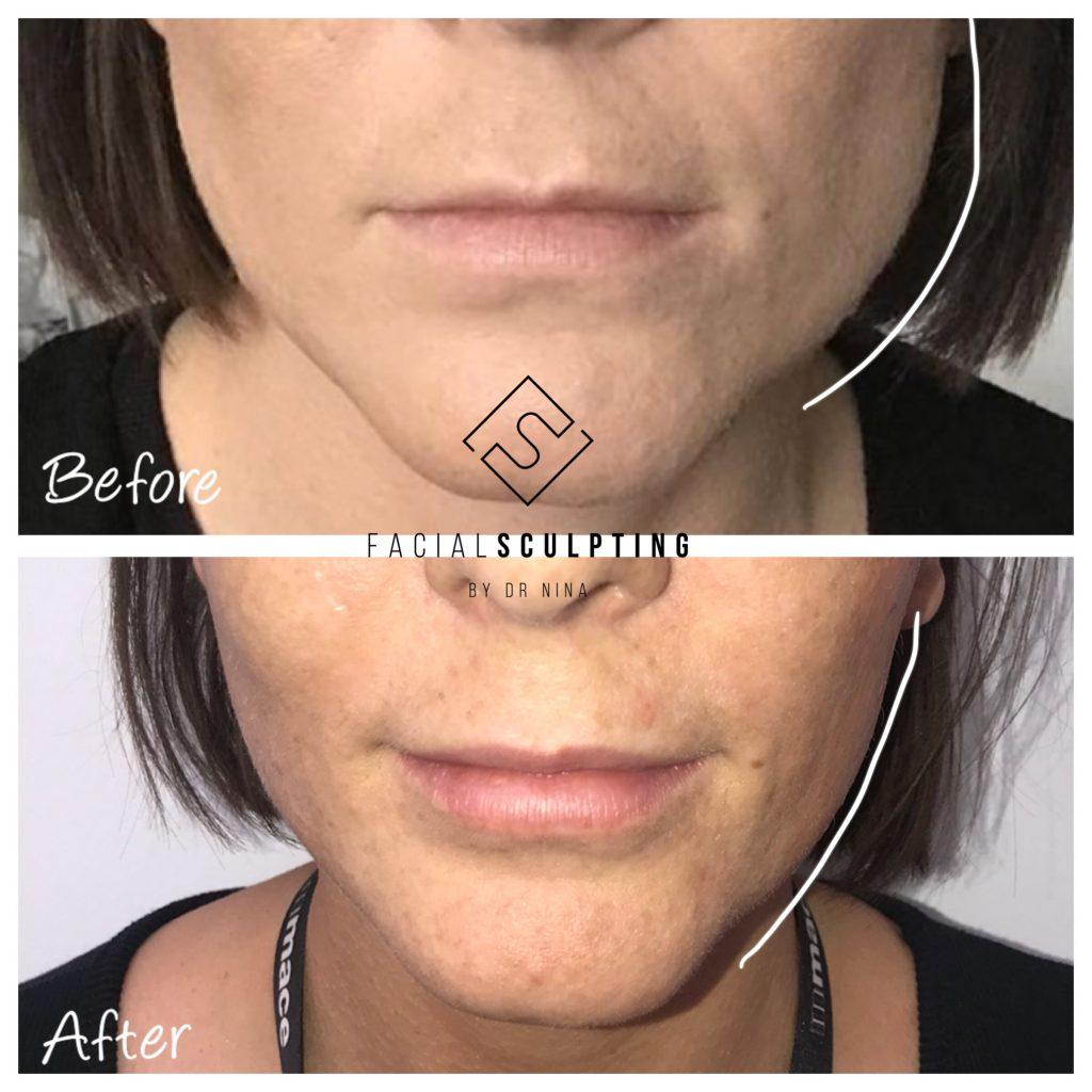 Best Botox London